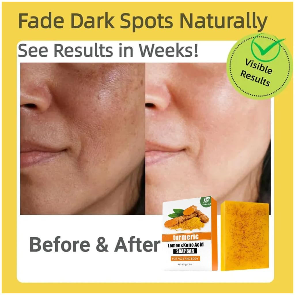 Turmeric and Kojic Acid Soap for Dark Spot Treatment – Brightening Formula with Lemon and Vitamin C – Enhanced Moisturization with Shea Butter for Face and Body 
